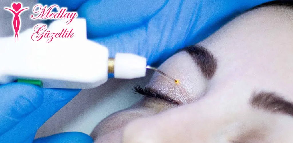 3. Sanayi Plexr Ameliyatsız Göz Kapağı Estetiği